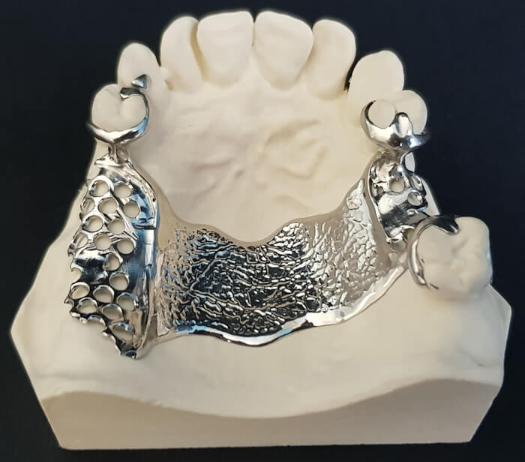 Radonić Dental Lab - Skeletirana proteza 6