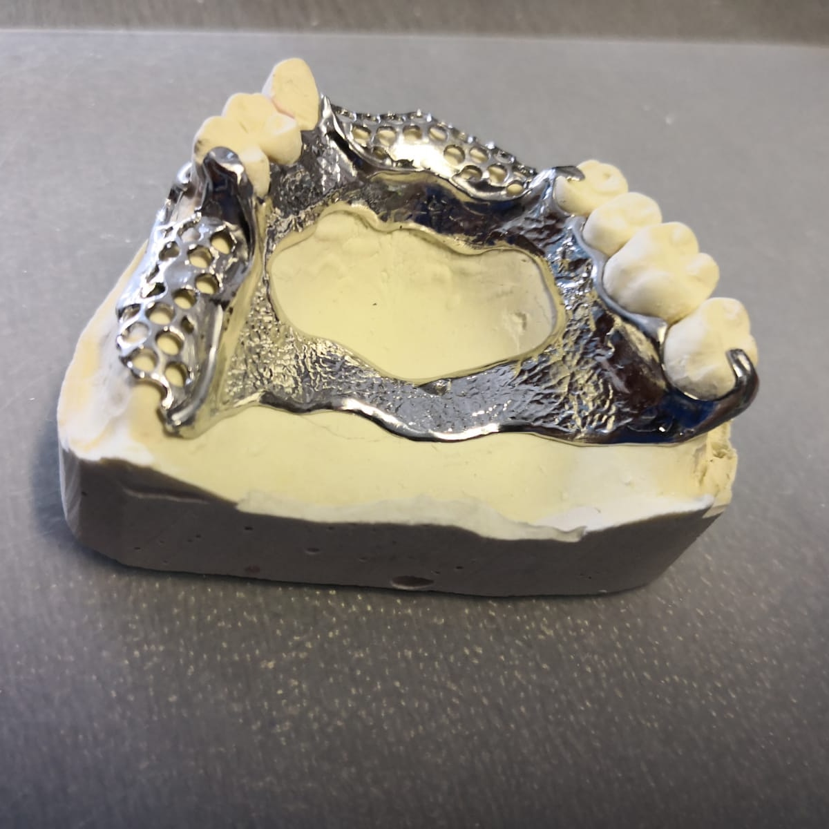 Radonić Dental Lab - Skeletirana proteza 2