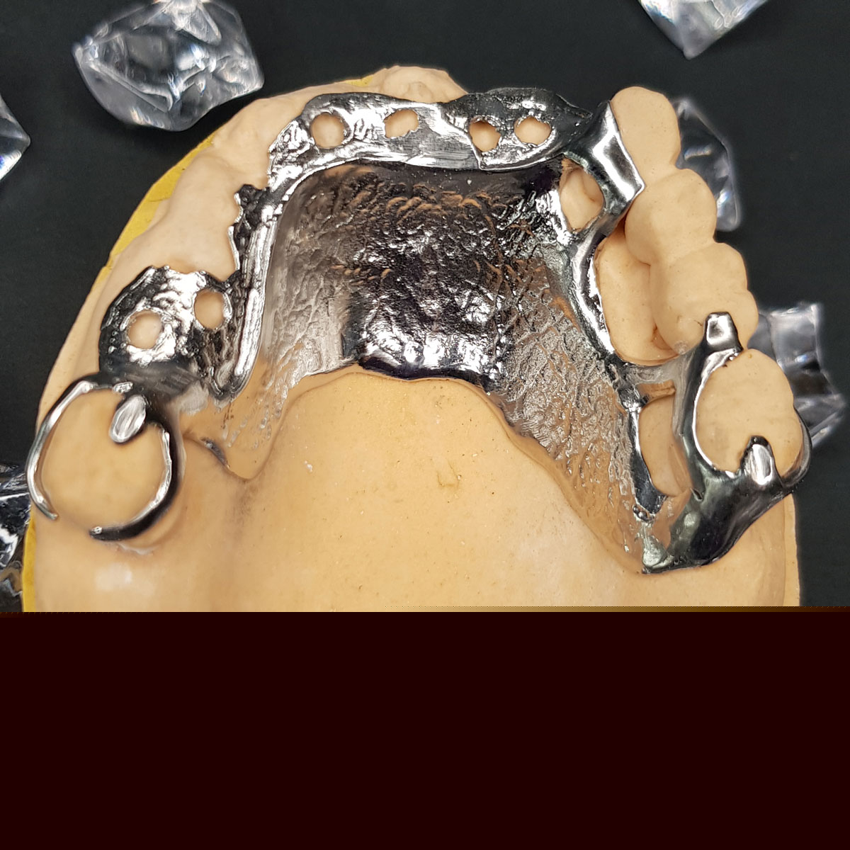 Radonić Dental Lab - Skeletirana proteza - vironit kristali 2