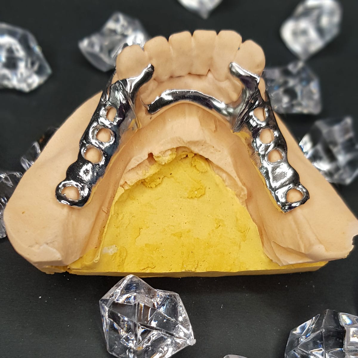 Radonić Dental Lab - Skeletirana proteza - vironit kristali 4